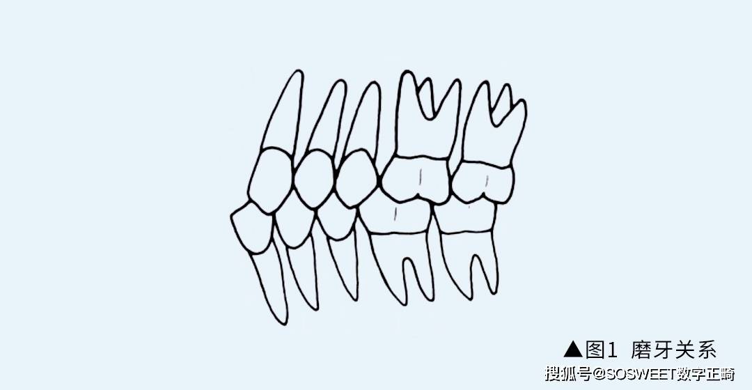 正畸科普 andrews的正常(牙合)六项标准
