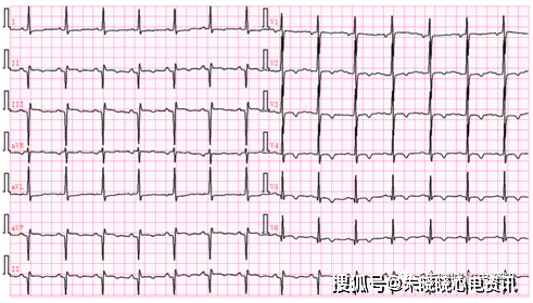 病理性q波的鉴别诊断