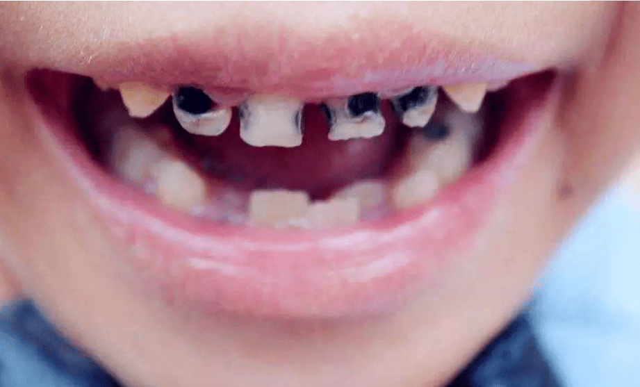 在孩子的口腔当中有所残留,而在晚上牛奶的乳液就会侵蚀孩子的牙齿