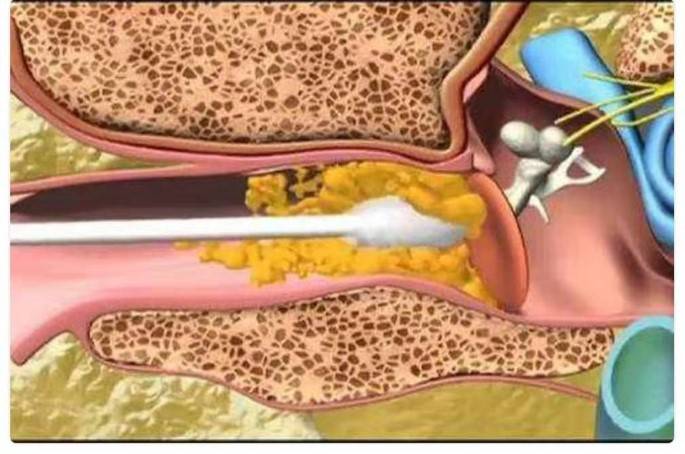 一下耳朵里的分泌物是怎么形成的:外耳道软骨部的皮肤内有耵聍腺存在