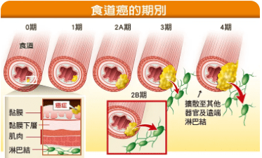 食道癌偏爱这几个省份,出现8种症状要当心!