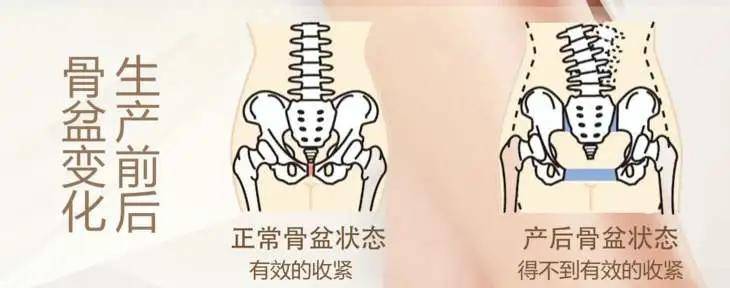 亲爱的妈妈们产后骨盆松弛比你想象更严重