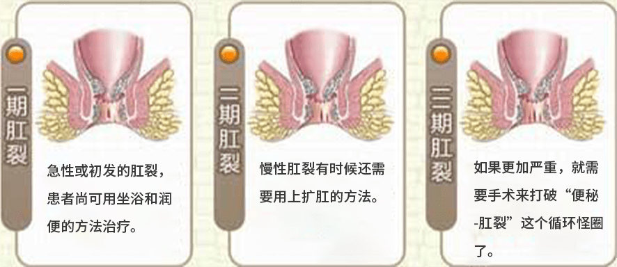 肛门疼痛伴便血,便秘,你以为的痔疮还可能是它