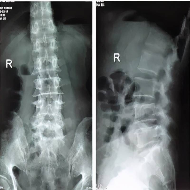 术后x-ray:脊柱侧凸基本矫正,腰椎生理曲度恢复正常.
