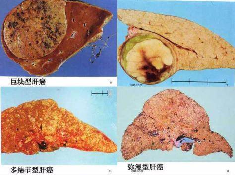 肝癌初期"不痛不痒",当出现4个"迹象",早做检查