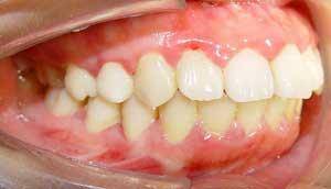 这8种牙齿畸形必须矫正