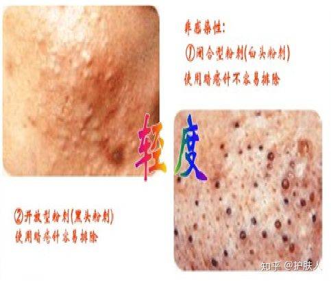 痘痘等现象,油性皮肤和混合型皮肤容易出现痘痘问题 皮肤特点:皮脂腺