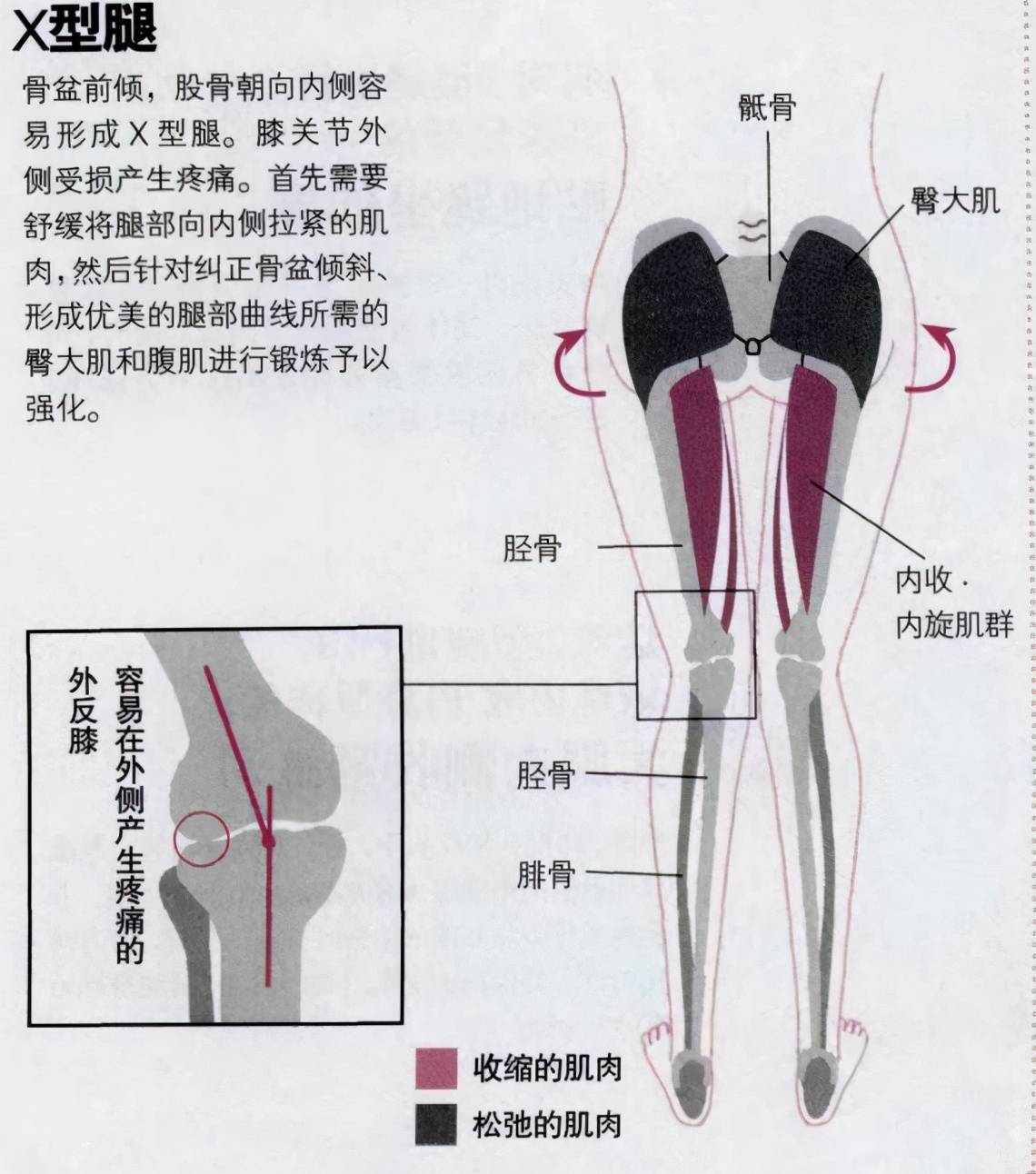 荒野健康:xo型腿如何靠按摩或锻炼矫正?