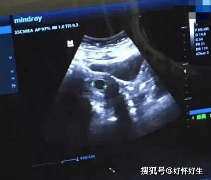 试管婴儿移植后会不会发生宫外孕?