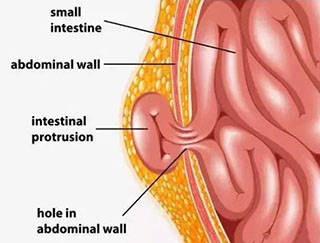 小孩子疝气怎么办