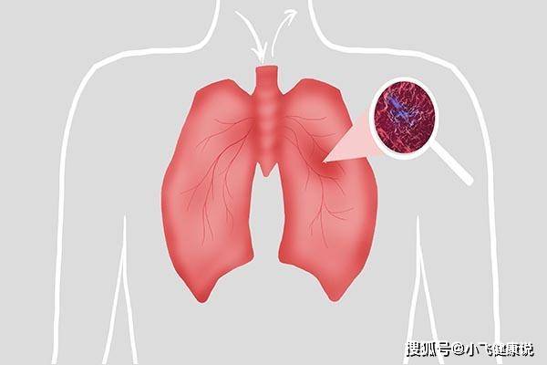 怎么才能得肺炎 aa66e830666a4c24b4b5c8c356b34e78.jpeg