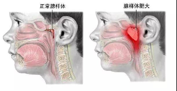 怎么看小孩有没有鼻窦炎 bfdb31f2ead94918bc525fc18f580808.jpeg