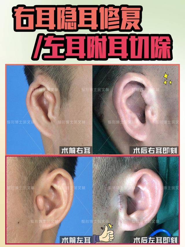 右耳隐耳左耳附耳,一次耳畸形修复手术,解决两个问题