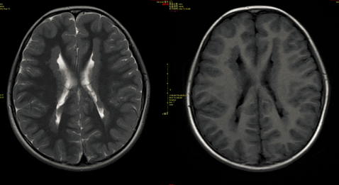 医影学堂丨八个病例带你看懂脑灰质异位的三种类型_畸形