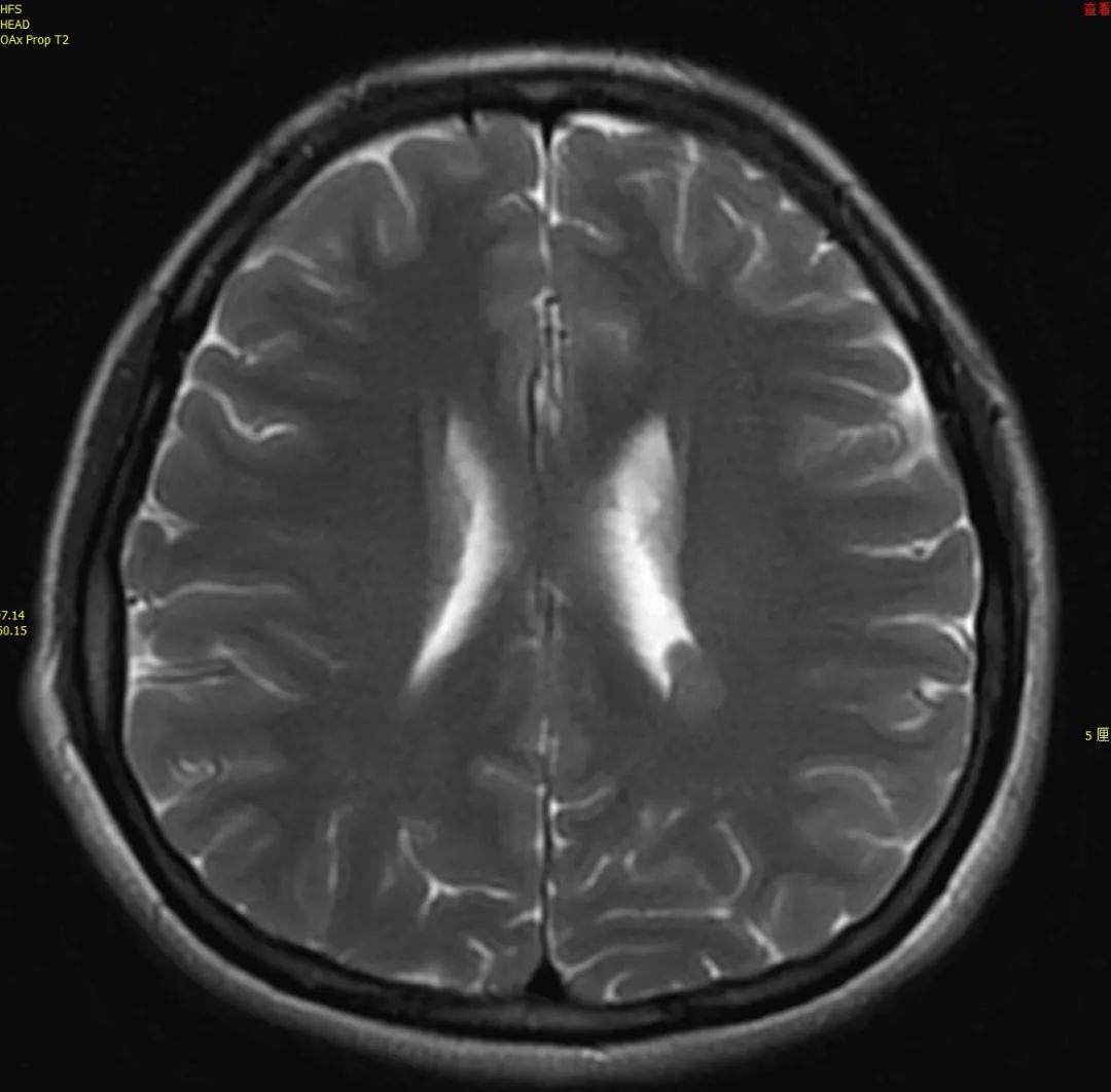 也可以合并中枢系统的其他畸形 脑裂畸形,胼胝体发育异常,巨脑回畸形