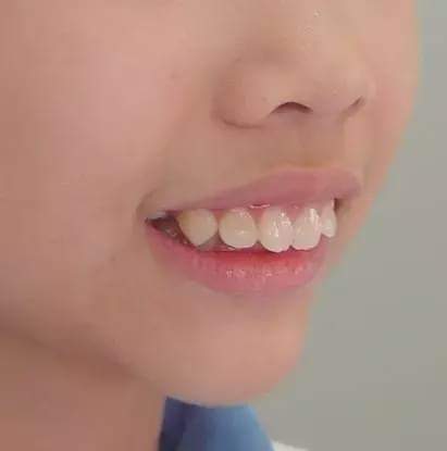孩子牙齿正畸从几岁开始最好?