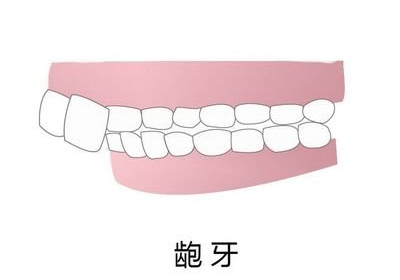 其实龅牙也分不同类别!