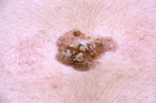 研究:肛门上皮内瘤变是肛门鳞状细胞癌的前体病变