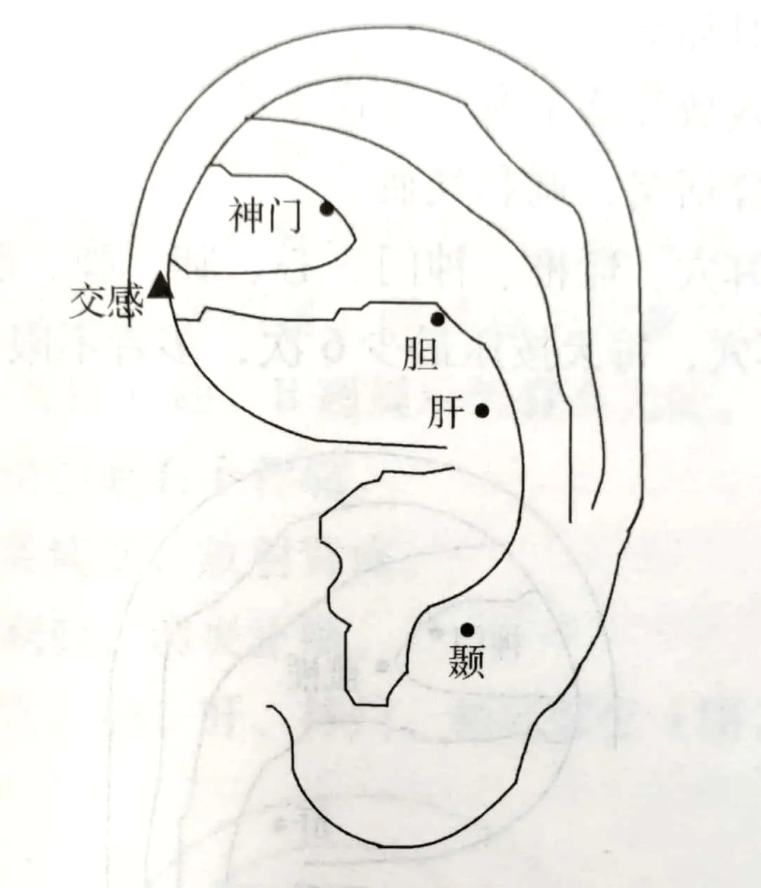 【治疗】取耳穴:颞,肝,胆,神门,交感(如图).