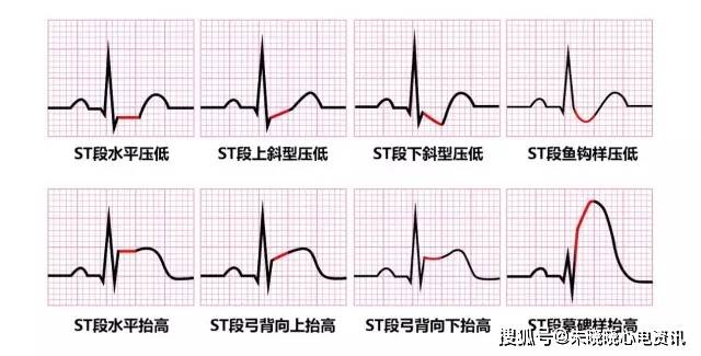 st 段上抬的时候形状更加多变,可以呈水平上抬,弓背向上抬高,弓背向下