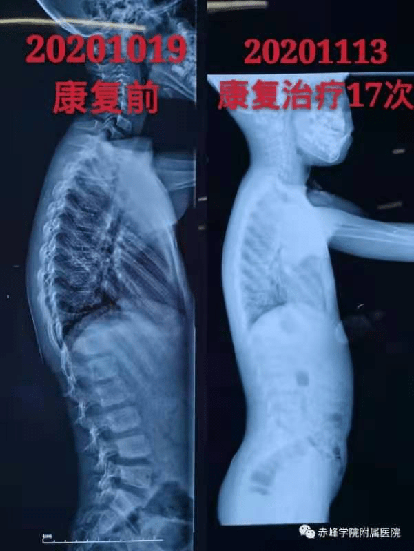 脊椎侧弯案例分享_脊柱