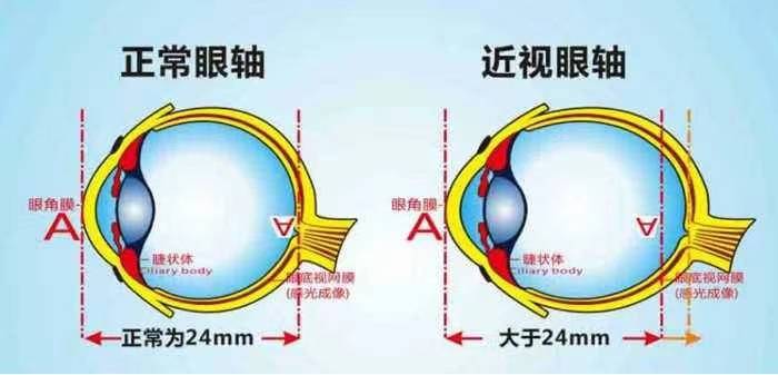 高度近视眼球快被撑爆一根兜带筑牢眼球地基