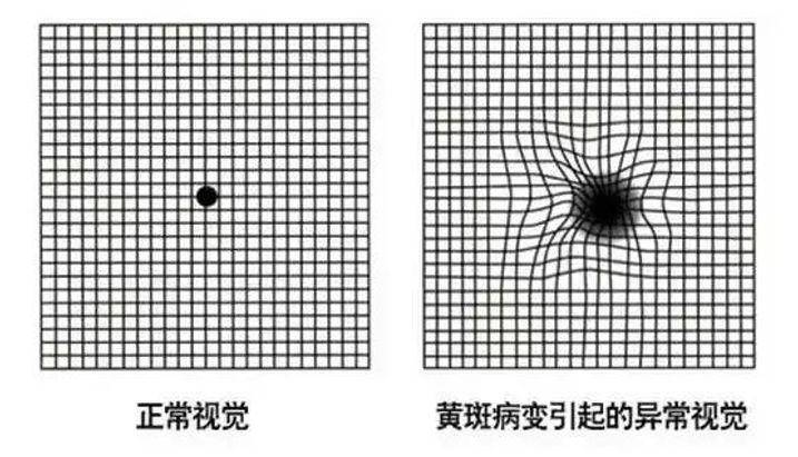 黄斑病变是什么?