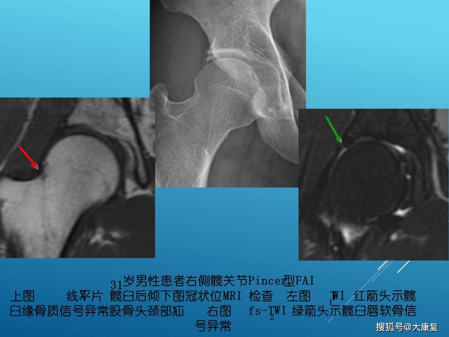 股髋关节撞击综合症