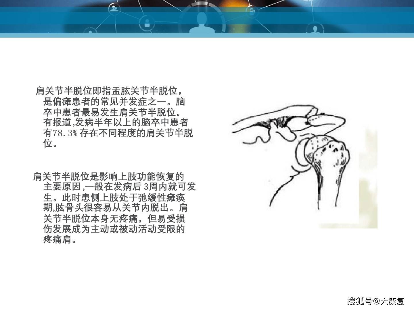 肩关节半脱位的治疗
