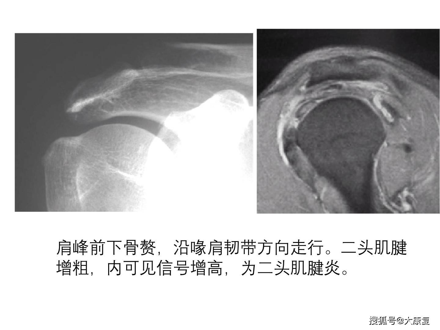 肩关节运动损伤影像诊断