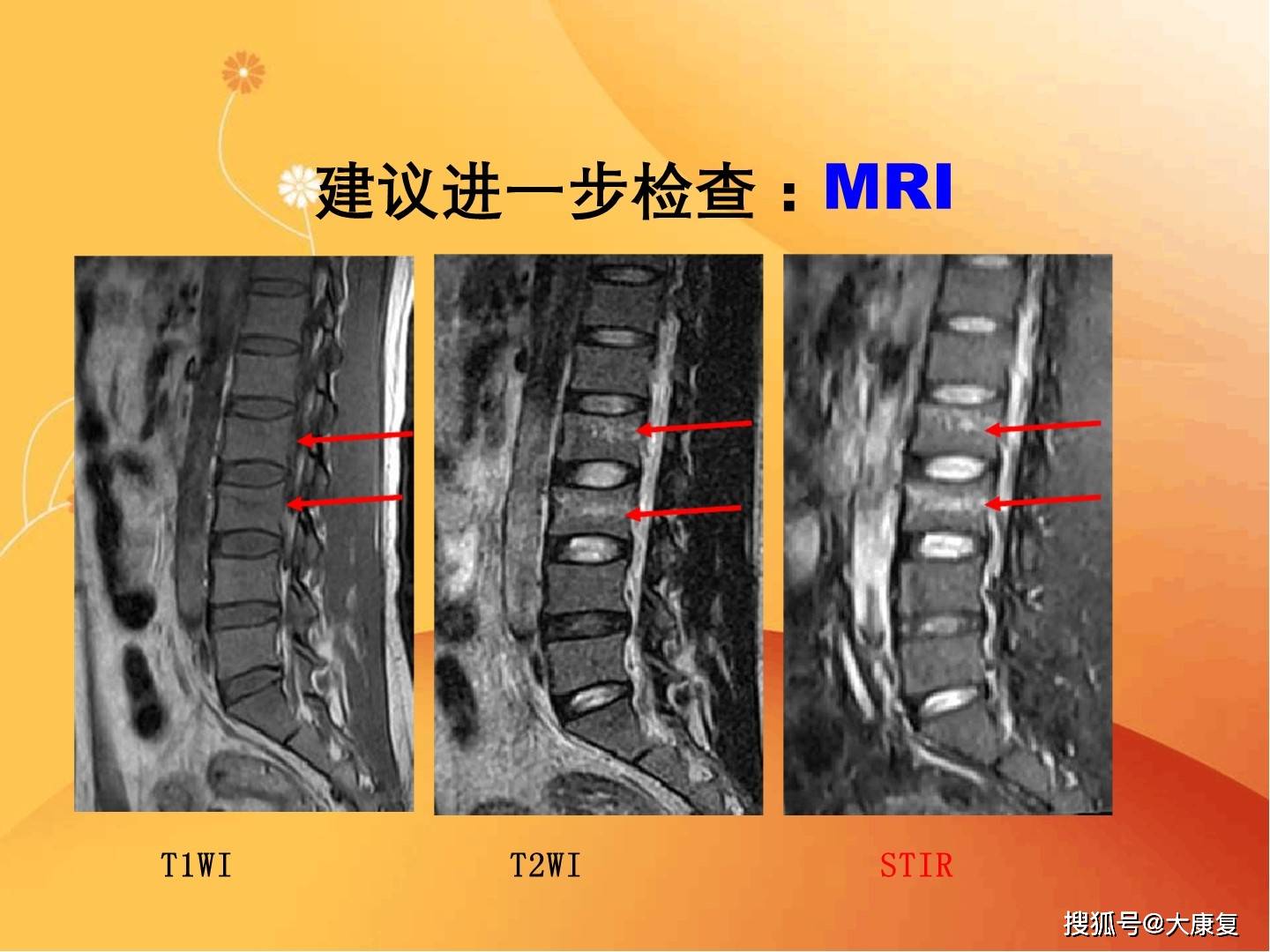 脊柱常见疾病的mri诊断