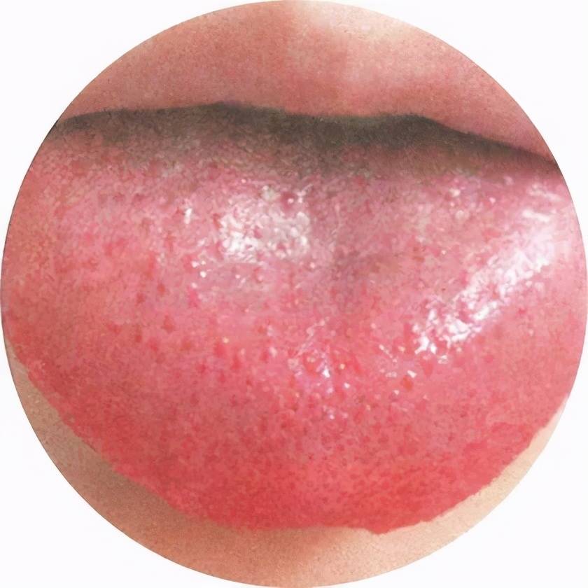 暗红 舌苔:薄白,微干 舌体:两边有齿痕 瘦红舌大多是由于肝肾阴虚,瘀