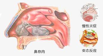 4,出血性息肉(较少)表面光滑,充血,触之软而易出血.