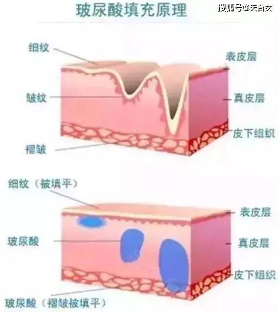 打了玻尿酸,玻尿酸代谢后皮肤会变得松松垮垮?