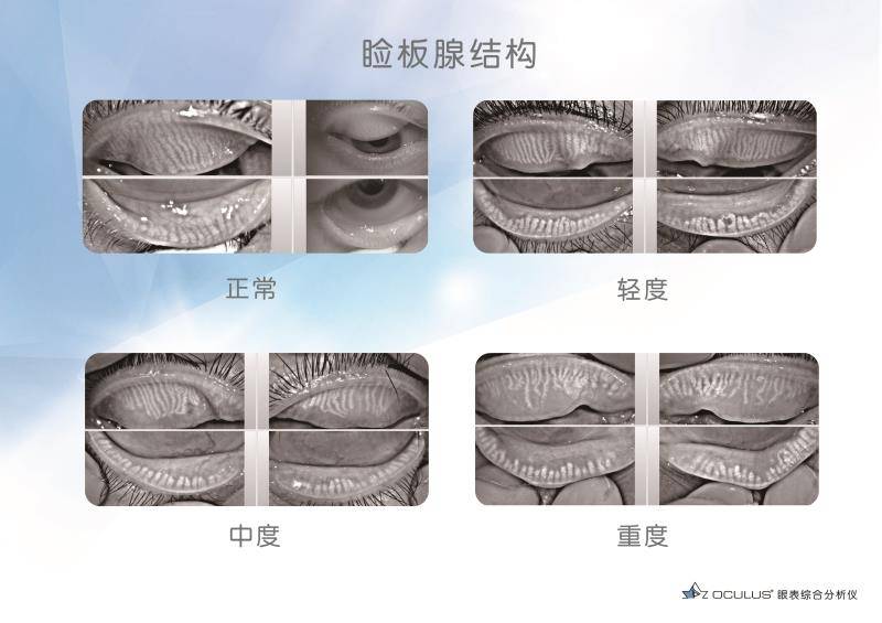 医院角膜与眼表科主任刘晓年表示,胡女士是典型的睑板腺功能障碍型干