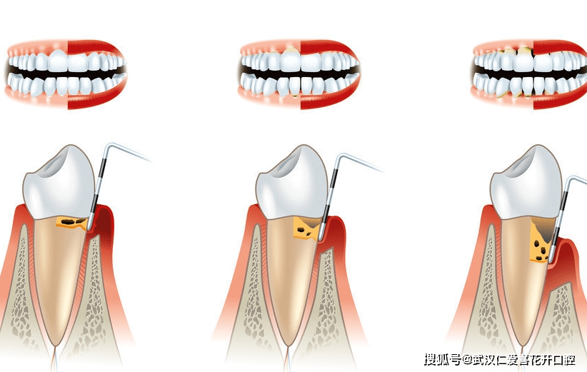 牙齿有这些症状多要小心,都是牙周炎惹的祸,拖久了治疗难花费高