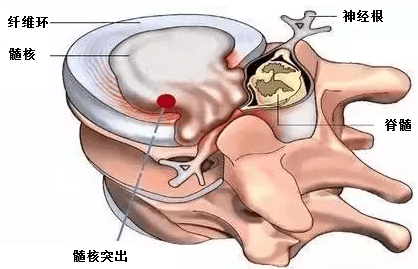 多节段腰椎间盘突出怎么办?微创理念下开放手术效果好