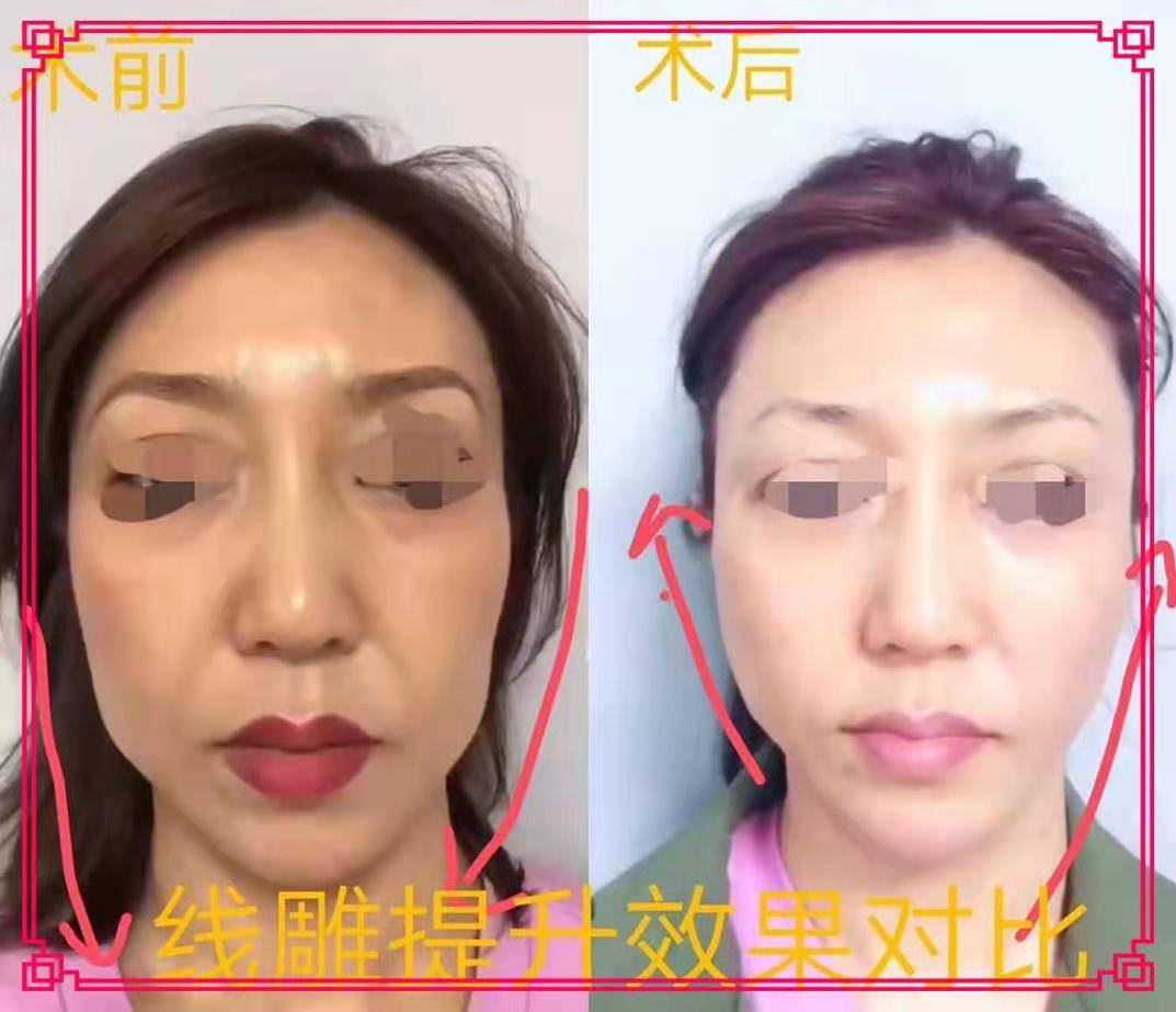 看婆婆线雕恢复期真实图片听耿直的小美说提线盾多久恢复