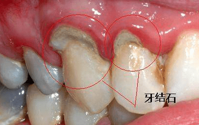 自测"牙结石"方法拿去!看看你的牙齿上有没有牙结石?