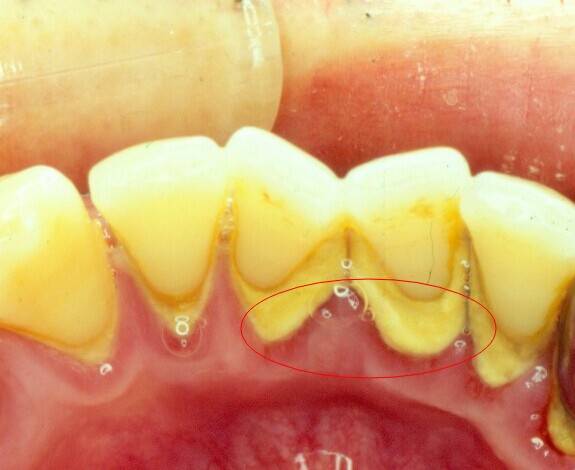 自测牙结石方法拿去看看你的牙齿上有没有牙结石