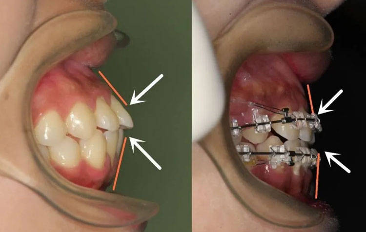 牙性嘴凸是由牙齿外凸,不整齐导致的颌面外凸.