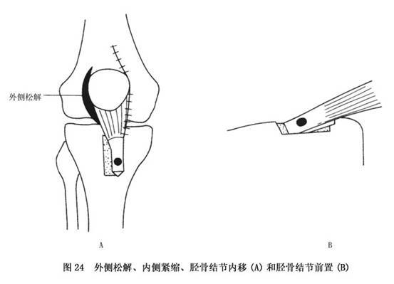 这类病人髌骨外侧牵拉的力量较内侧大,因此髌骨会被往外侧牵拉而导致