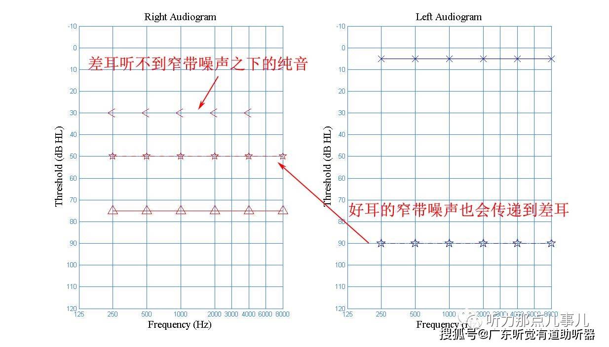 纯音测试手把手教你做骨导掩蔽