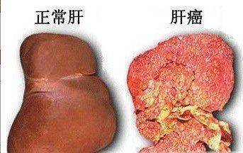 牵涉痛,疼痛部位不一定是病变部位,而肝癌所致右肩痛