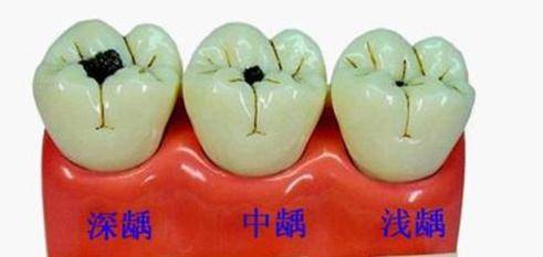 原创牙齿上有"小黑点",是什么原因?能不能用洗牙方法去除呢?