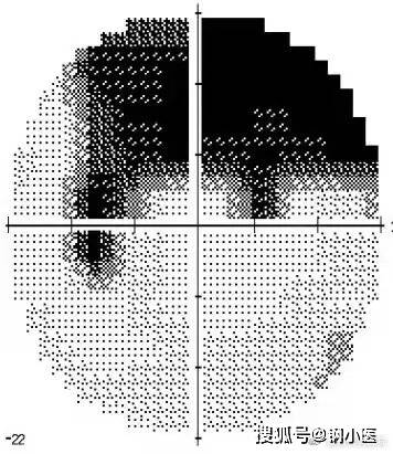 图片鼻侧阶梯视野图片正常视野图片视野检查:下列图为电脑视野计检查