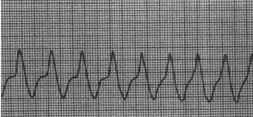 比较室速于室扑的心电图波形(如上)注:第一张为室扑,第二张为室速5