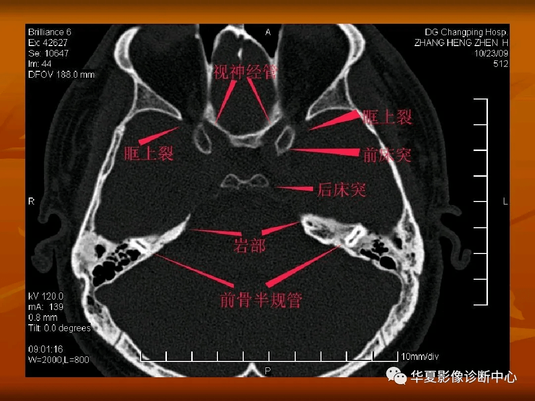 颅底ct高清图解 常见骨折部位图示