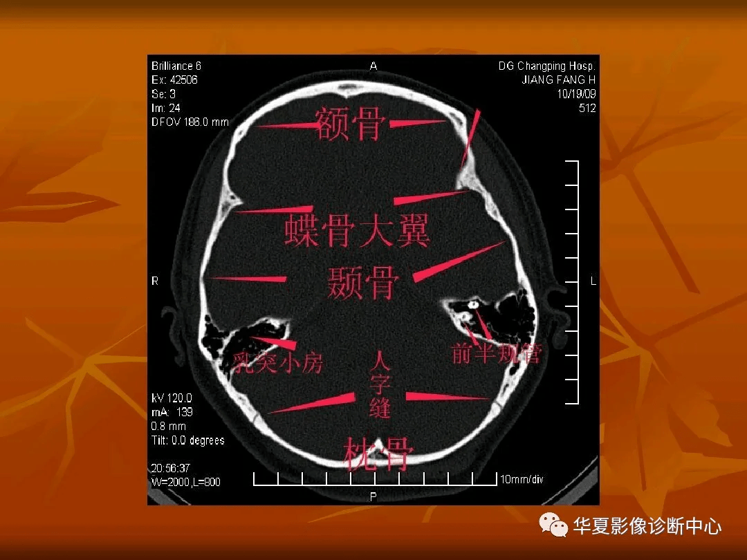 颅底ct高清图解 常见骨折部位图示