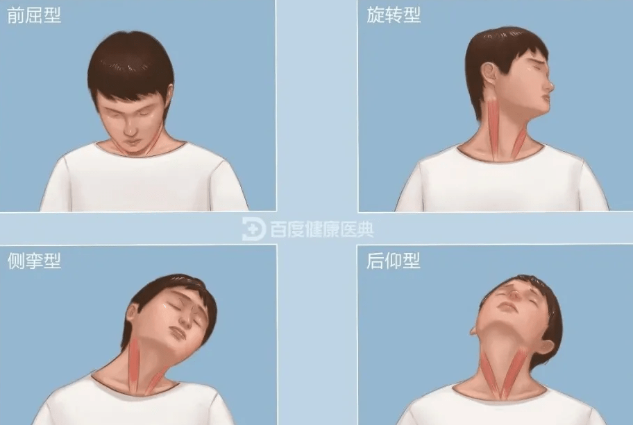 拿什么拯救痉挛性斜颈呢?